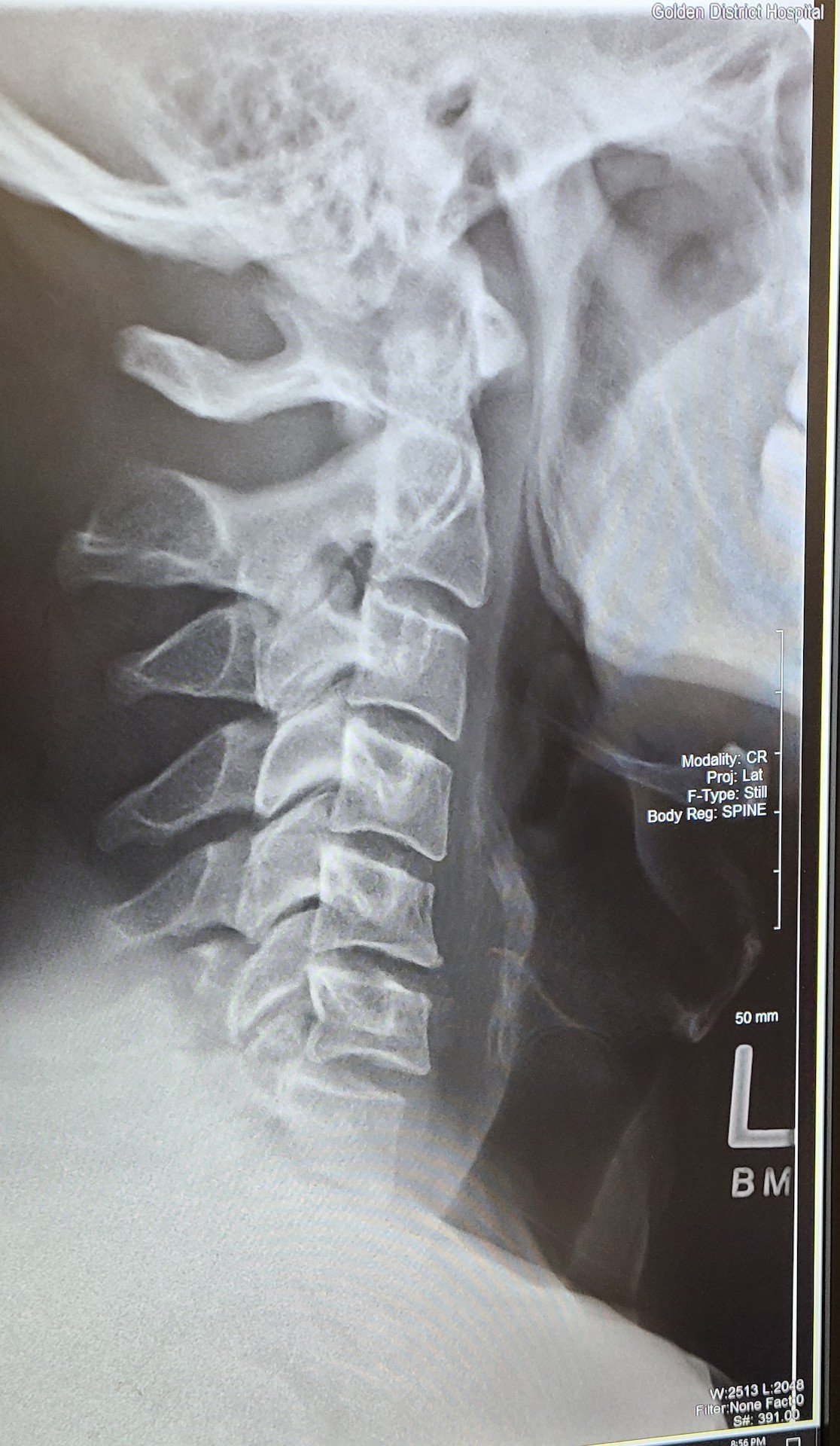 neck injury 1
