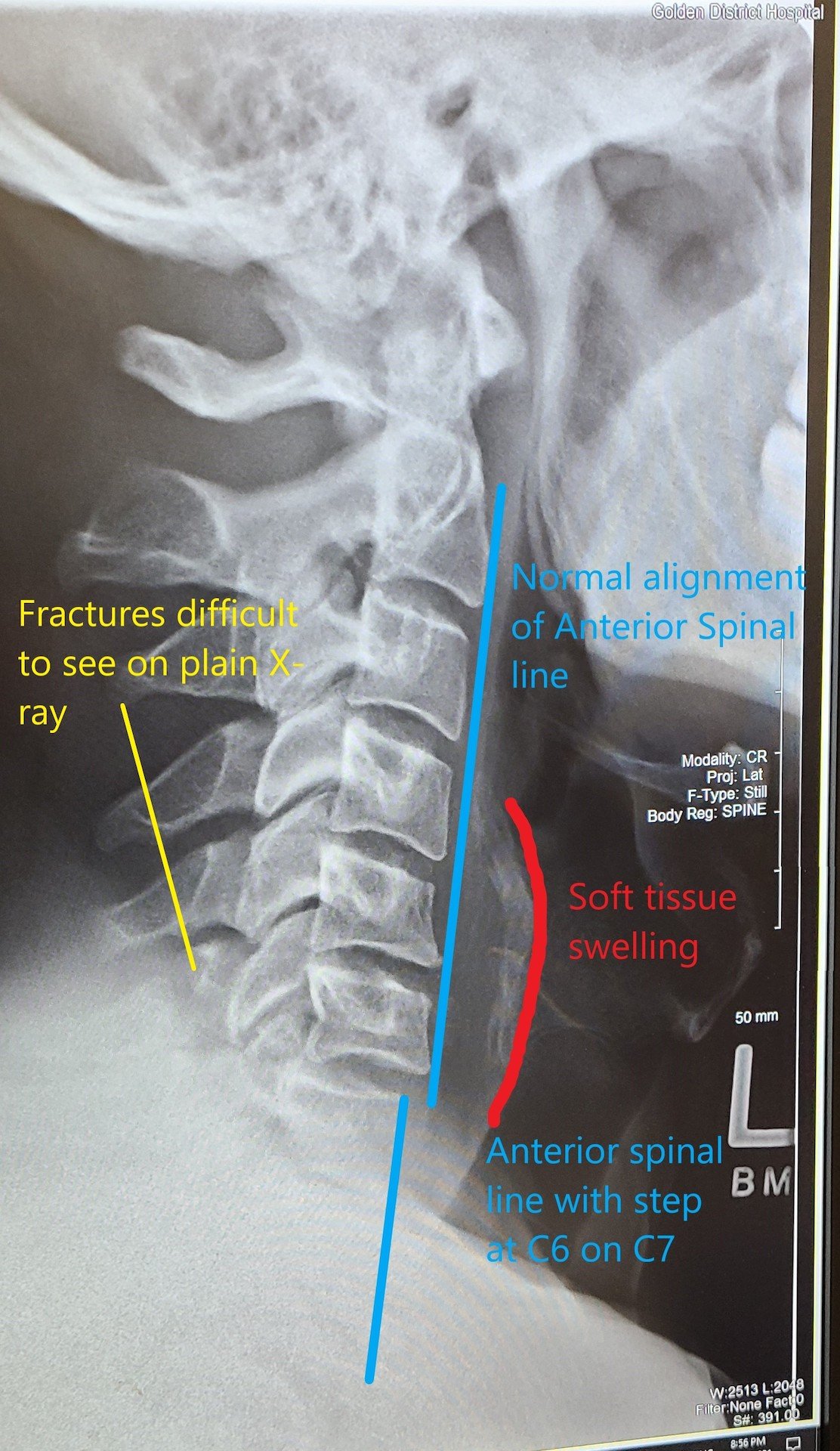 spine diagram